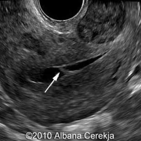 📃 Uterine synechiae