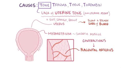 Boggy Uterus: What Is It, Causes, Treatment, and More | Osmosis