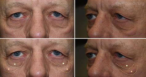 Festoon vs. Lower Eyelid Dermatochalasis