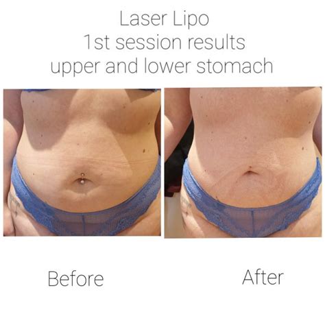 Laser Lipo - Changing Faces