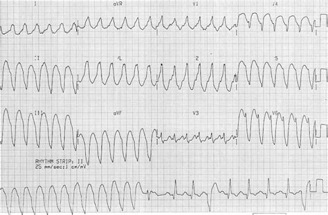 Ventricular Tachycardia Vt Ecg Criteria Causes Classification | My XXX Hot Girl