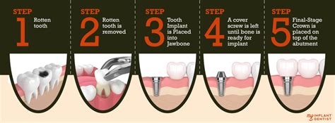 Dental Implant Procedure - Step by Step Guide