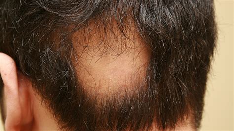 Stem Cell Treatment for Alopecia Areata ( Hair Loss ) in Delhi, India - StemCellCareIndia | Home