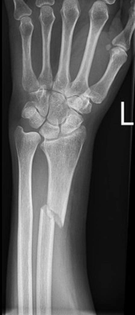 Galeazzi fracture - wikidoc