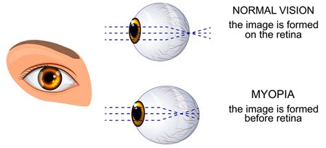 Short-Sightedness (Myopia) - Exeter Eye