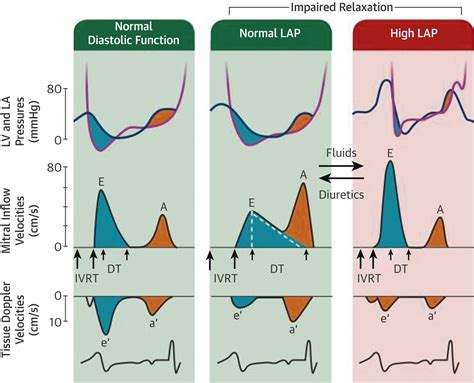 Left Ventricular Diastolic Function: Understanding Pathophysiology, Diagnosis, and Prognosis ...