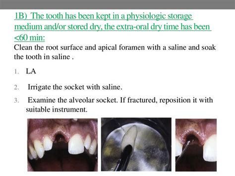 Guidelines for the management of avulsion