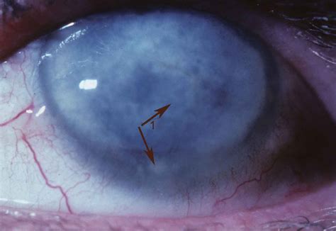 Ocular Pathology: What is macular dystrophy of the cornea?