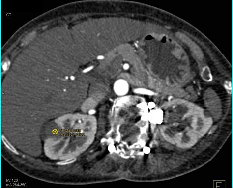 Cyst with Septation Right Kidney - Kidney Case Studies - CTisus CT Scanning