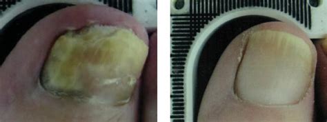 Laser Therapy For Toenail Fungus Specialist - Clifton, NJ: Premier Podiatry: Velimir Petkov, DPM ...