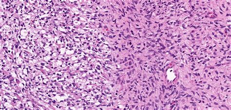 Malignant Tumor Histology