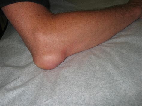 Harbor Hospital Resident's POW: Swollen elbow