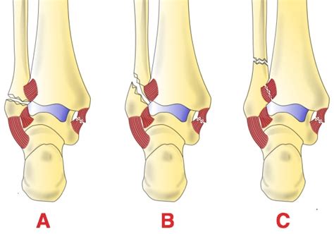 Tibia and Fibula Fractures - Management - Reduction - TeachMeSurgery