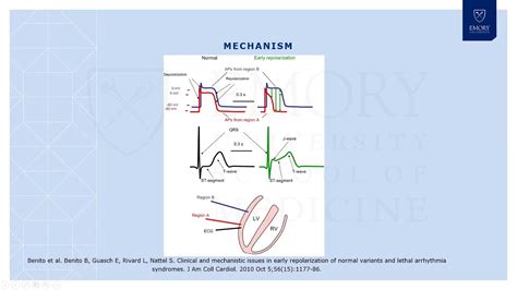 Early Repolarization Syndrome - YouTube