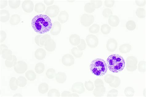 Toxic granulation & Döhle inclusion bodies - Hematomorphology, a ...