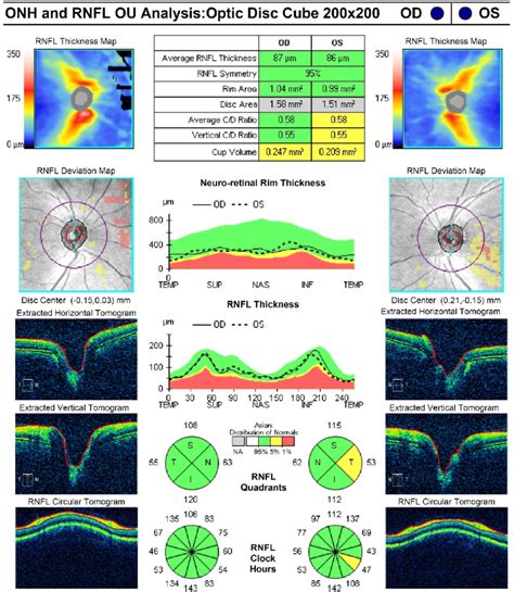 Normal RNFL thickness in optical coherence tomography. ONH = optic ...