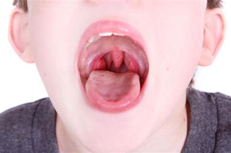 Signs of Strep Throat: Scott N. Bateman, MD: Ear, Nose and Throat ...