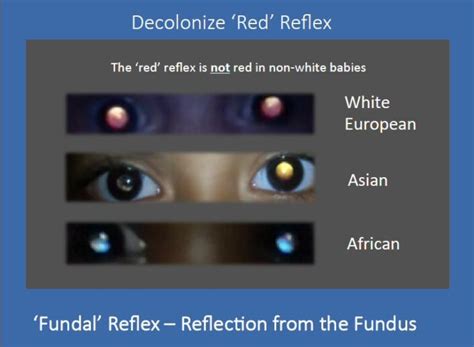 Fundal (Red Eye) Reflex and Red-Eye Reduction - WE C Hope