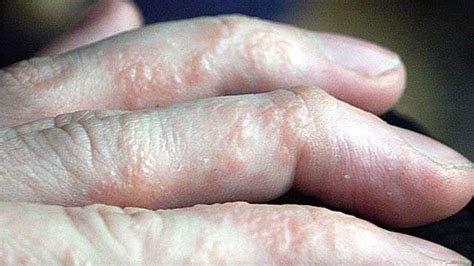 Types of Eczema: Identification, Pictures, and More