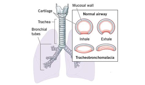 Symptoms of Airway Malacia - Interventional Pulmonology in Goa & Konkan - Dr Prabhu Prasad N C