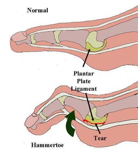 Podiatrist Gold Coast | Experienced Gold Coast Foot Care Specialists | Plantar Plate Tear