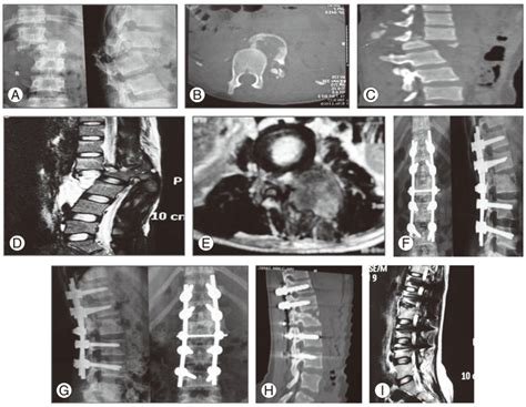 L1/L2 fracture dislocation in a 35-year-old female as a result of fall ...