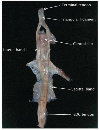 Extensor Tendon Surgery | Plastic Surgery Key