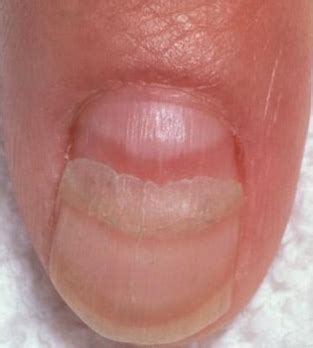 Ridges in Fingernails, Toenails, Vertical, Horizontal, Causes, Vitamin Deficiency, Treatment and ...