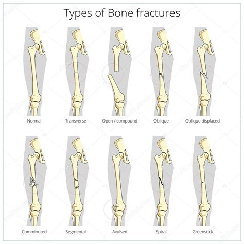 Types of bone fractures medical educational vector — Stock Vector © AlexanderPokusay #88701622