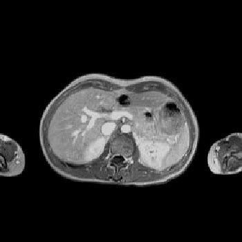 MRI Images - MRI Upper Abdomen T1 with Contrast - MR-TIP.com