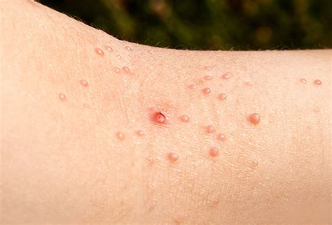 What are warts? - Richmond Hill Cosmetic Clinic