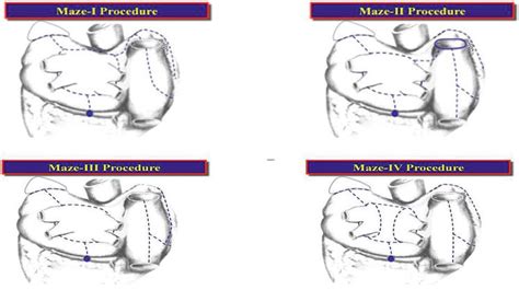 Surgical Treatment of Atrial Fibrillation | IntechOpen