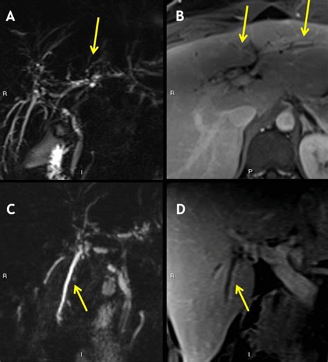 Biliary dilatation and enhancement in PSC. a MRCP showing beaded ...