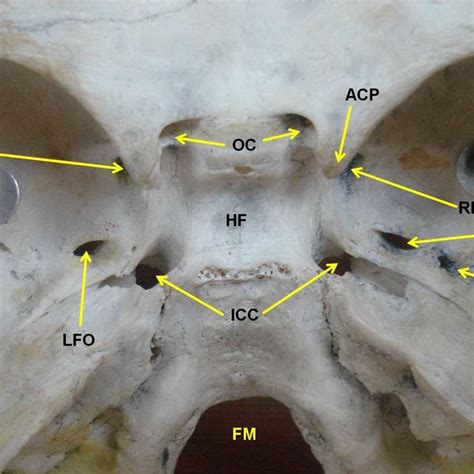 Photograph of the middle cranial fossa showing confluent foramen ovale... | Download Scientific ...