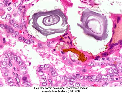 Papillary Thyroid Cancer Psammoma Bodies