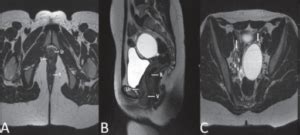 Mullerian Duct Anomalies — Classification and Development