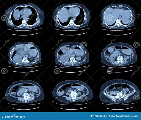 Mri scan abdomen stock photo. Image of diagnosis, display - 178859648