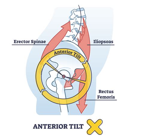 Anterior Pelvic Tilt: 3 Stretches and 3 Exercises to Remedy - Inspire US