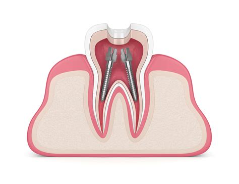 What Is a Root Canal Procedure? - Park Plaza Dental