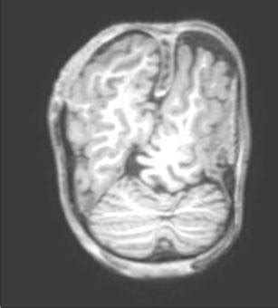 MRI noting defect in the falx cerebri and migration of the left... | Download Scientific Diagram