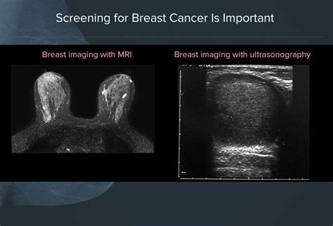 Mammography Screening Guidelines