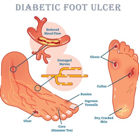 Diabetic Foot Problems – Know What Happens to Your Feet and Legs Due to ...