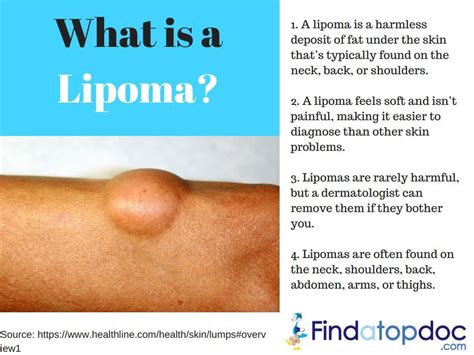 A Lipoma is a growth of fatty tissue that slowly develops under your ...