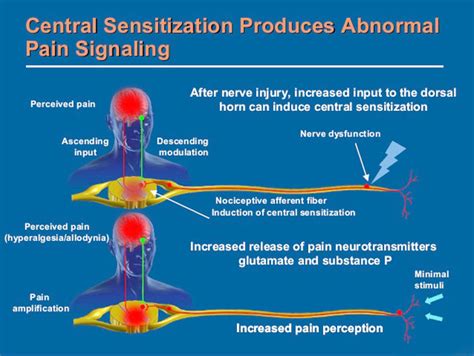 Fibromyalgia Pain Causes And Chiropractic Care - Injury Medical Clinic