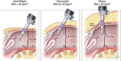 Basic Principles and Anatomy for the Laparoscopic Surgeon | Abdominal Key