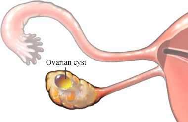 LAPAROSCOPIC OVARIAN CYST – CSF Surgery