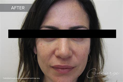 B and A - Juvederm Ultra Under Eyes (38 yo) | Concierge Aesthetics