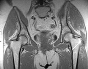 Gluteus Minimus Tear & Trochanteric Bursitis | Radsource