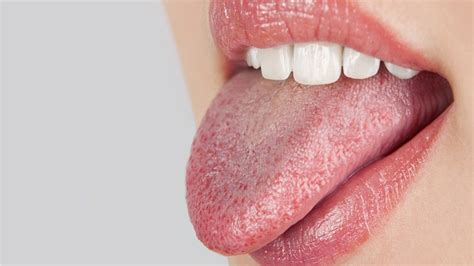 Dry Mouth - Symptoms, Causes, Complications And Risk Factors