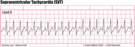 Psvt Ecg / Dr. Smith's ECG Blog: Paroxysmal SVT (PSVT) that ...